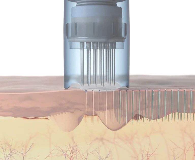 1-Microneedling corporal