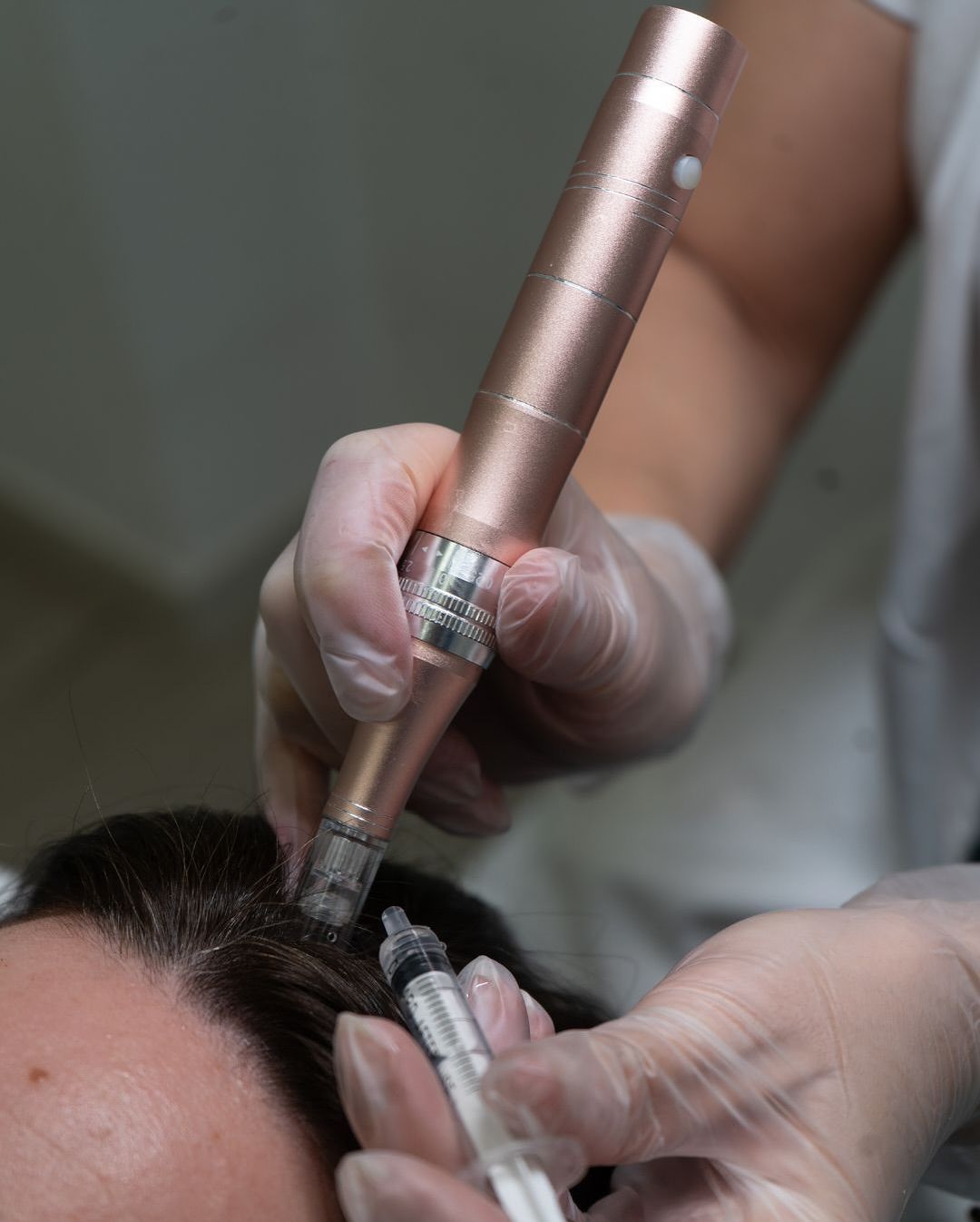 1. Mesoterapia capilar