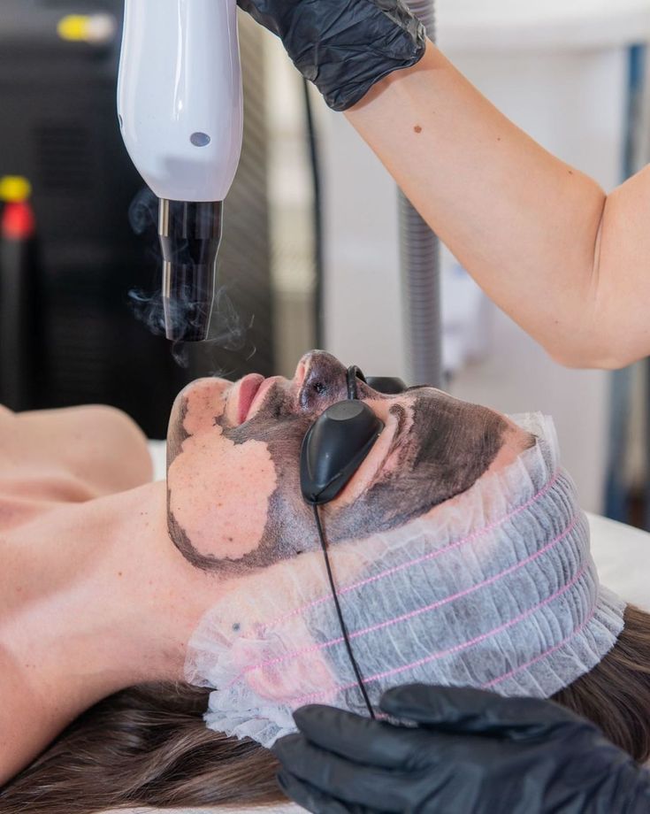 10.Hollywood Laser Peel