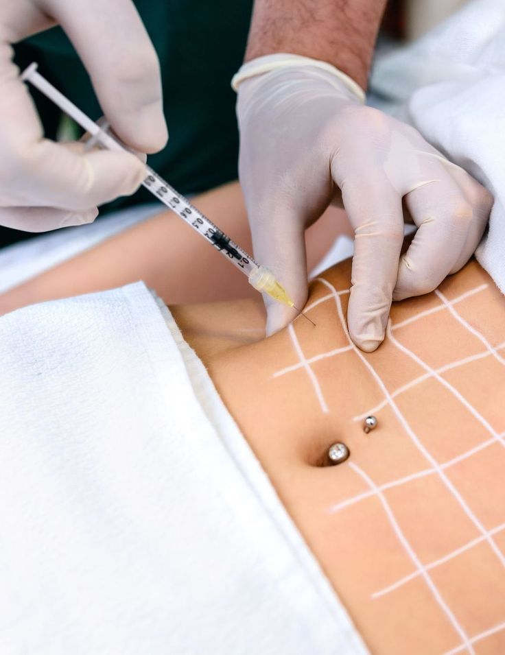 12.Mesoterapia corporal