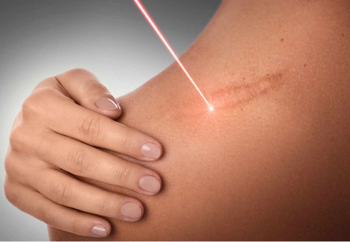 3-Tratamientos para cicatrices