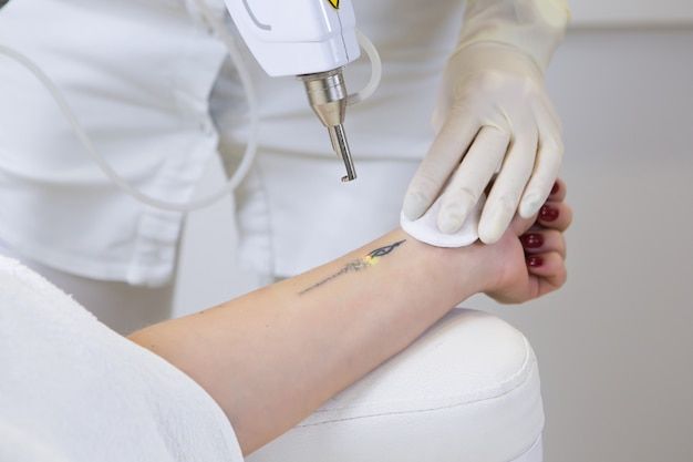9.1. remocion de tatuajes