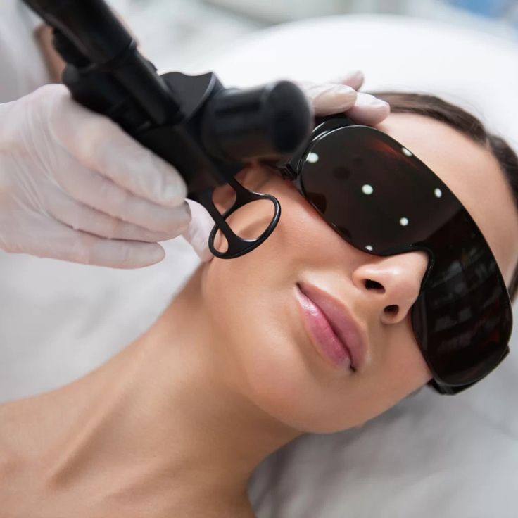 Láser CO2 facial