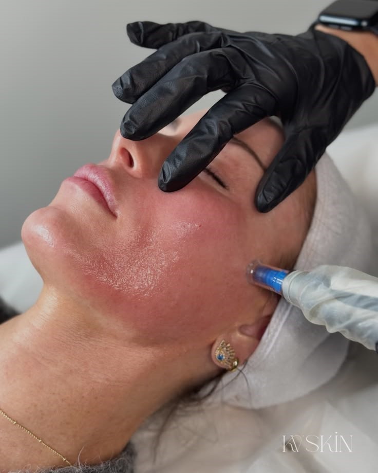 Microneedling facial