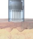 1-Microneedling corporal