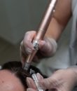 1. Mesoterapia capilar