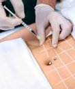12.Mesoterapia corporal