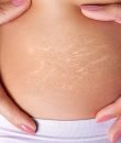 2-Tratamientos para estrías