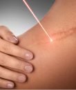 3-Tratamientos para cicatrices