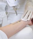9.1. remocion de tatuajes