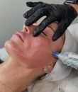Microneedling facial