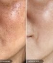 Tratamientos para manchas